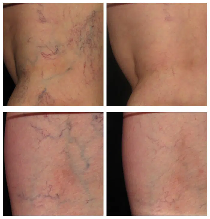 Sclerotherapy - Spider Veins - Reticular Veins