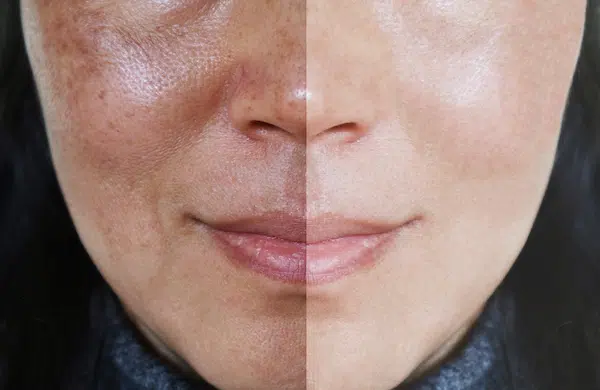 Hollywood Spectra Melasma Treatment